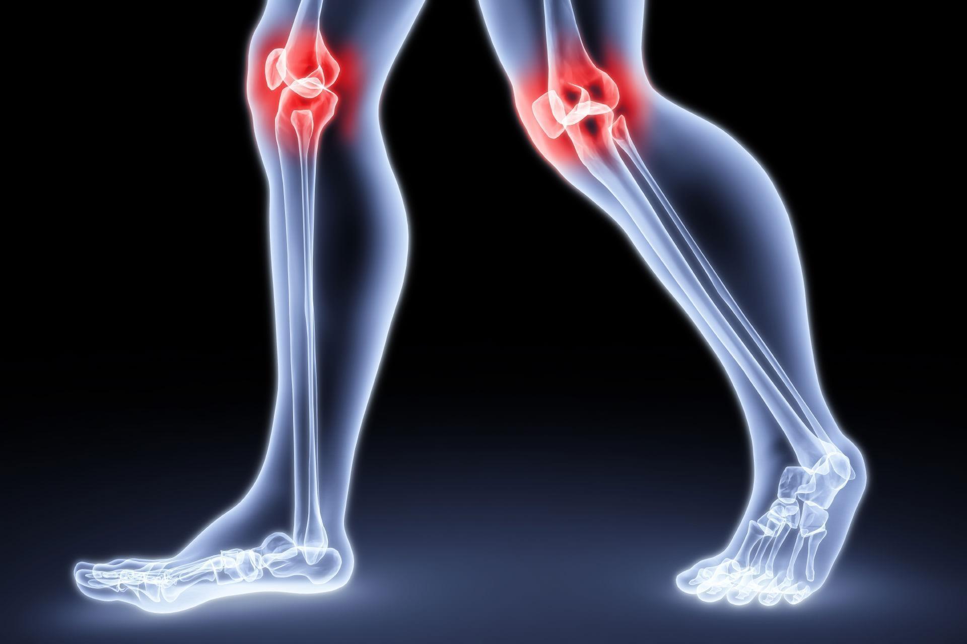 Сильно болят суставы ног. Реактивный синовит коленного сустава. Экссудативный синовит коленного. Хронический синовит коленного сустава.