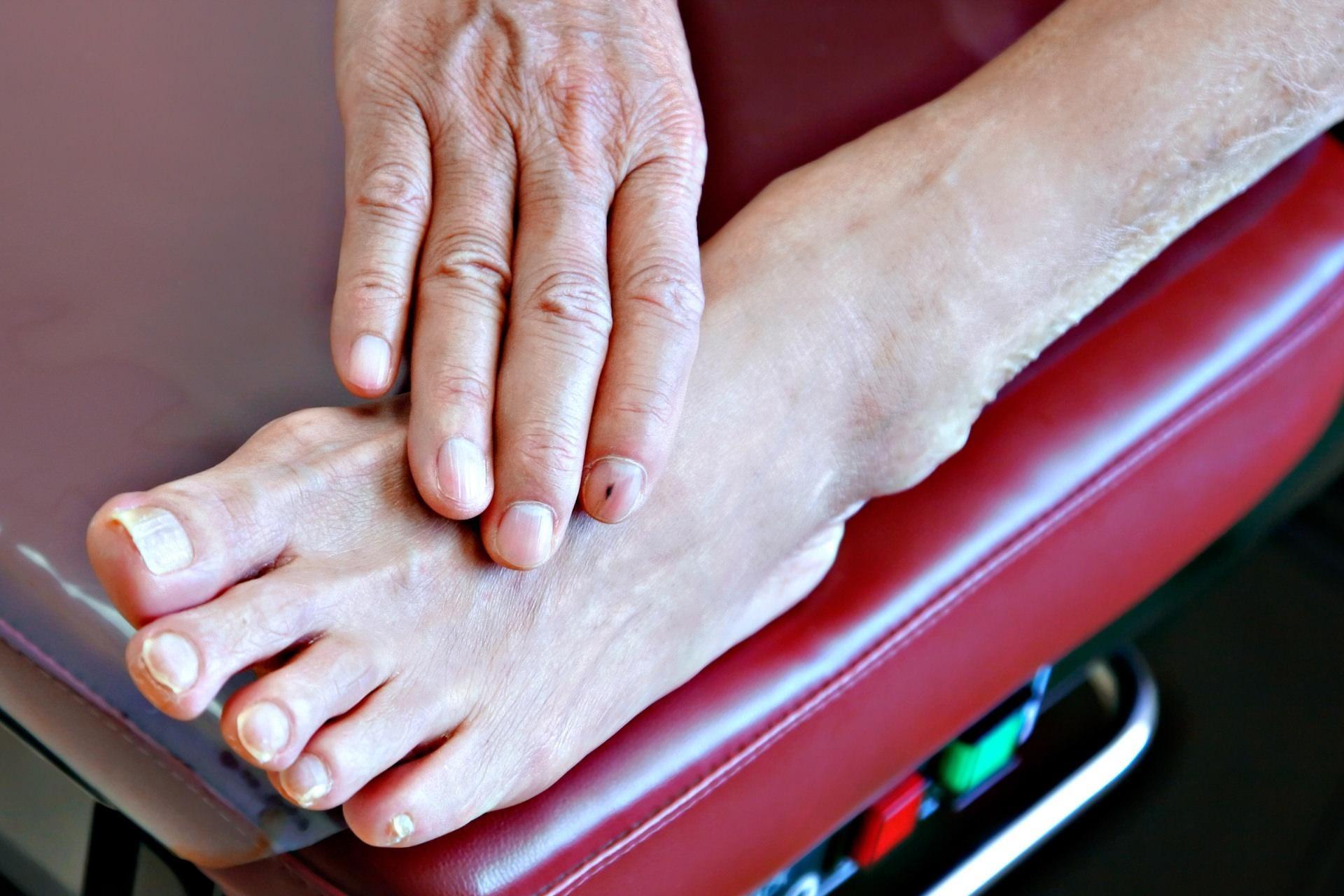Анемия стоп. Сахарный диабет ногти на ногах. Ногти пожилого человека на ногах.
