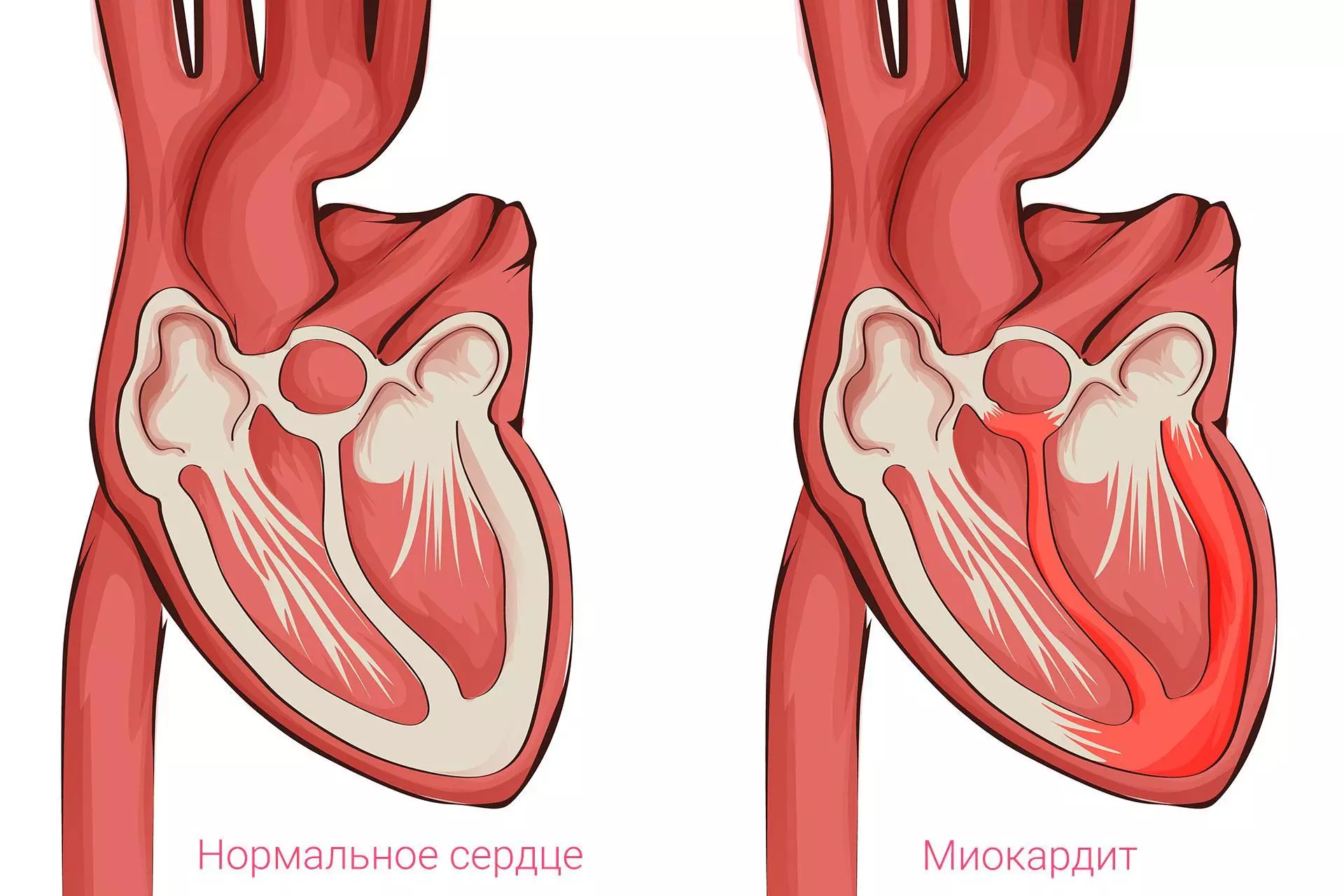 Лечение миокардита