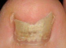 Удаление ногтевой пластинки при грибковом поражении