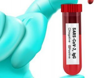 Тест на коронавирус 1500 рублей (на антитела к коронавирусу SARS-CoV-2, IgG (anti-SARS-CoV-2, IgG))